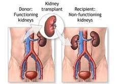 Kidney Transplant