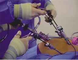 Liposuction in India