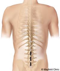 Spinal Surgery India