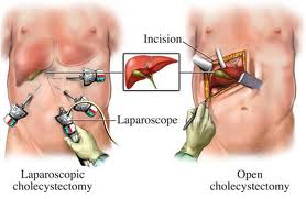 Laparoscopic Surgery India